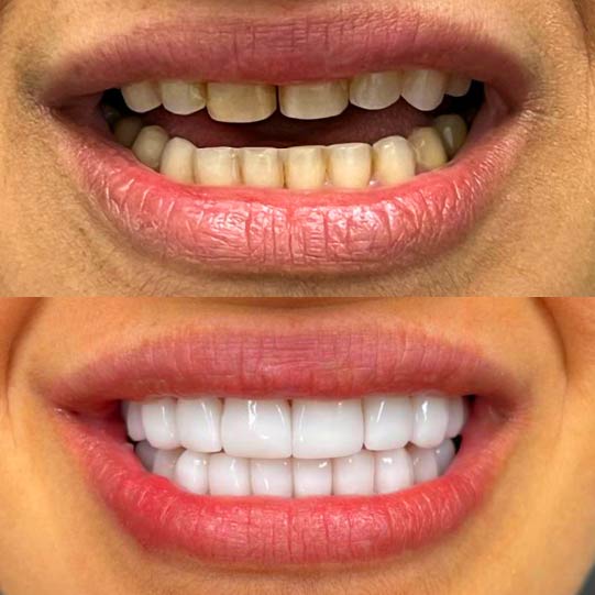 diseño de sonrisa cali